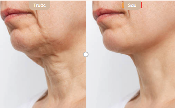cách giảm nọng cằm nhanh