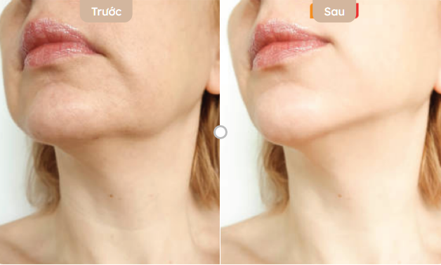 cách giảm nọng cằm nhanh