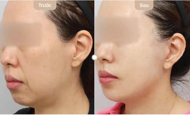 cách giảm nọng cằm nhanh
