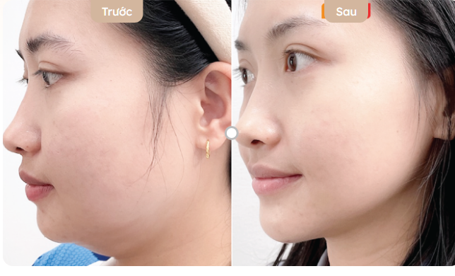 cách giảm nọng cằm nhanh