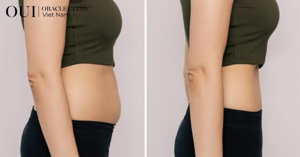 siết dáng công nghệ cao