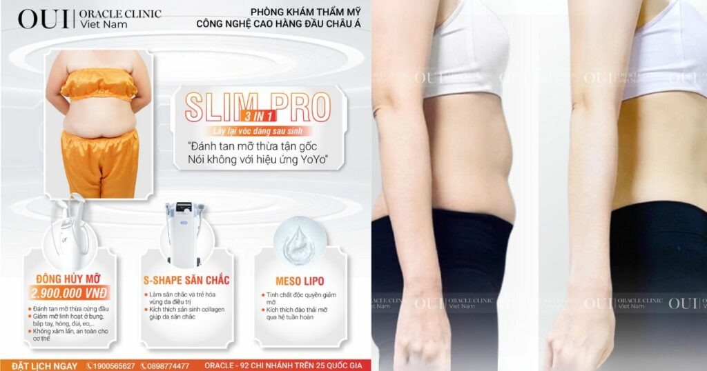 siết dáng công nghệ cao