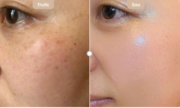 Skin Booster có hiệu quả không