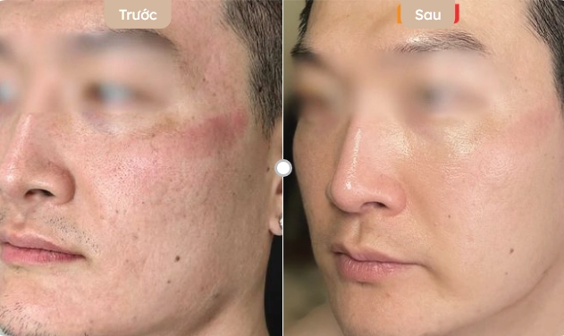 Skin Booster có hiệu quả không