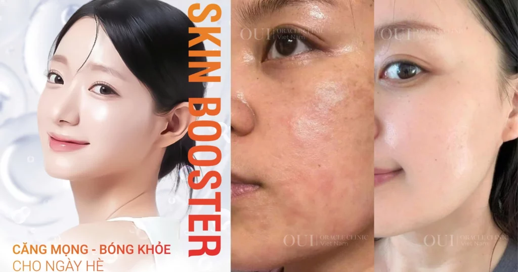 Skin Booster có hiệu quả không