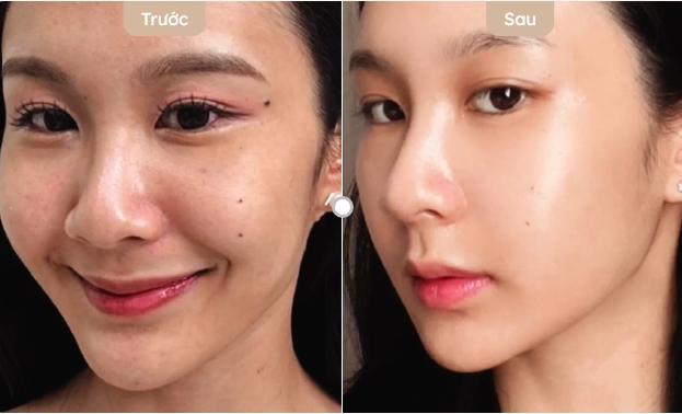 Skin Booster có hiệu quả không