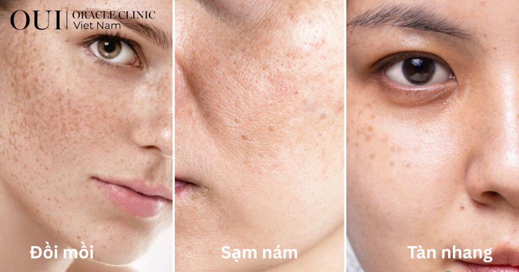 tia UV gây lão hóa da như thế nào gây sạm nám và đồi mồi