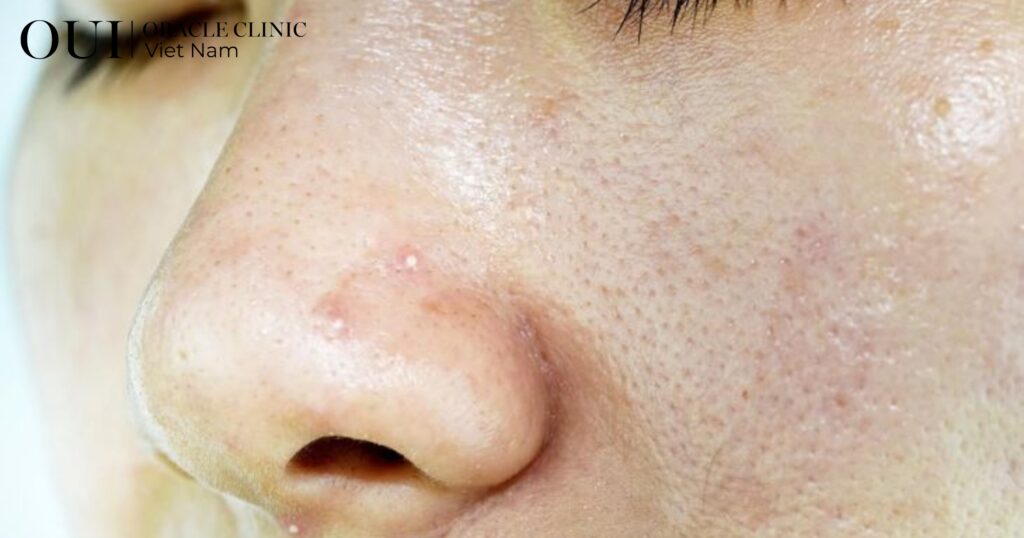 tia UV gây lão hóa da như thế nào suy yếu hàng rào bảo vệ da
