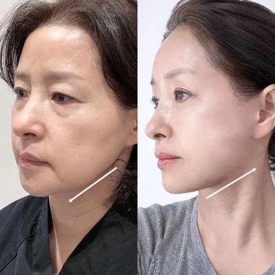 Trẻ hóa da sau 30