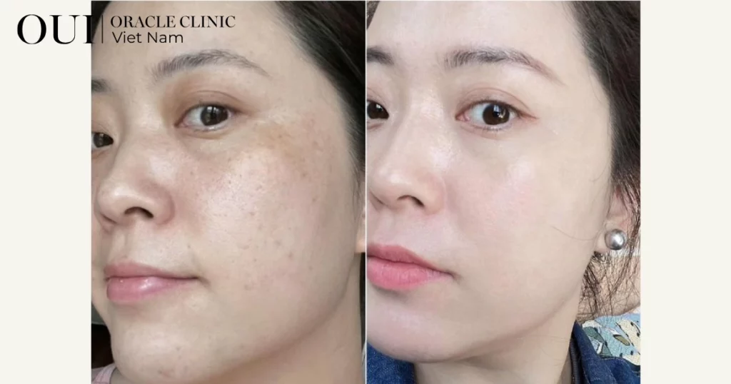 trị nám mùa hè có nên không
