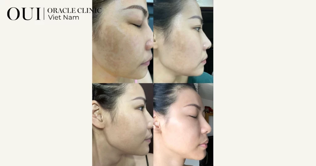 trị nám mùa hè có nên không