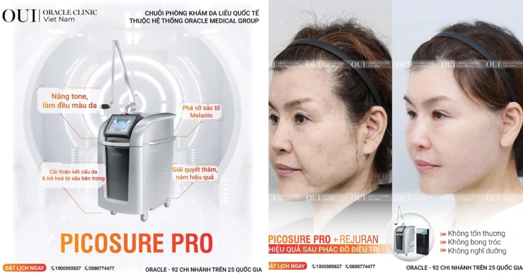 trị nám mùa hè có nên không