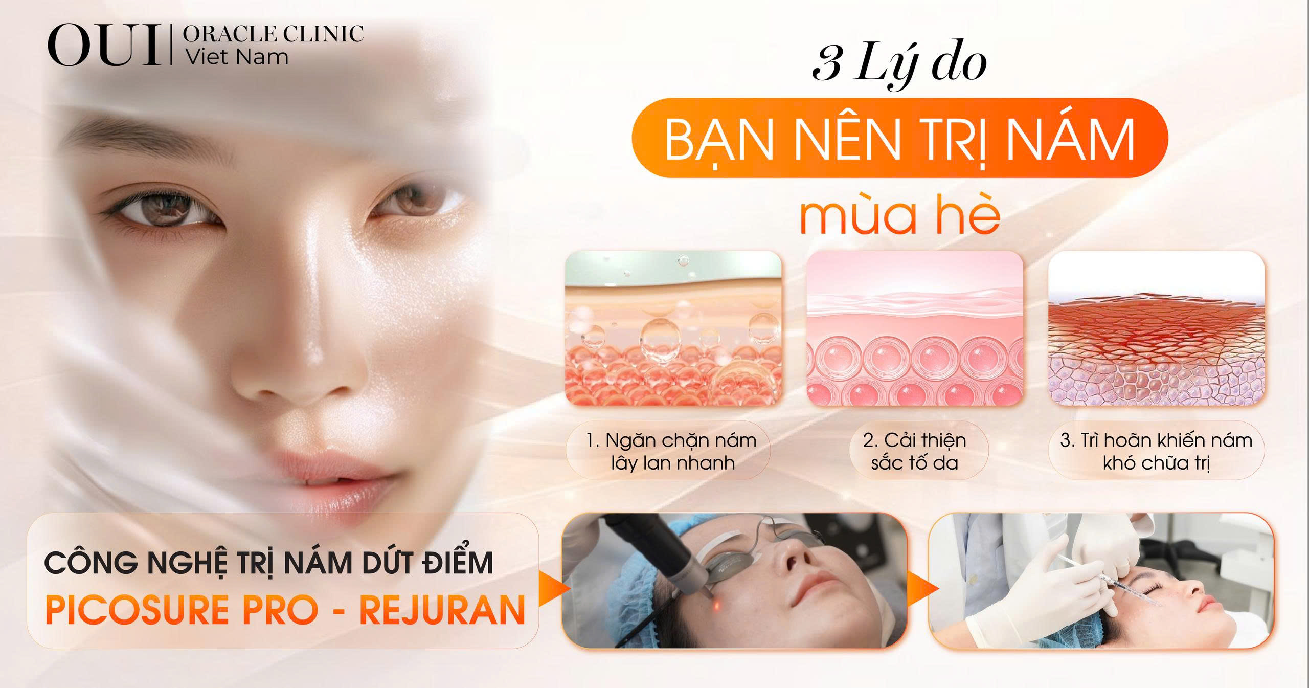 trị nám mùa hè có nên không