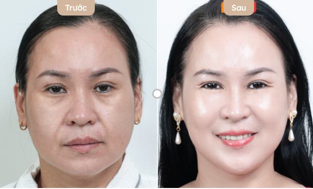Trẻ hóa da sau 30