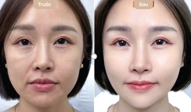 Nâng cơ có bị chảy xệ lại không
