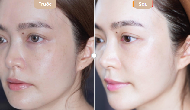 Nâng cơ có bị chảy xệ lại không