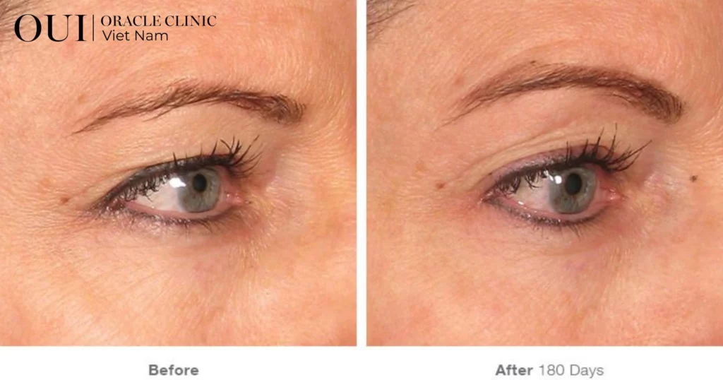 ultherapy có hiệu quả không