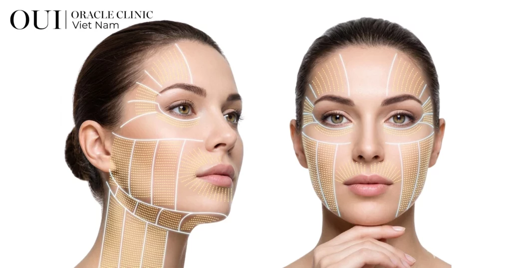 ultherapy có hiệu quả không