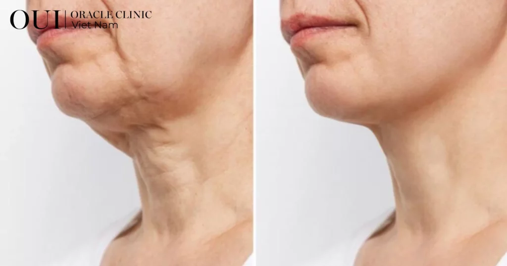 ultherapy có hiệu quả không