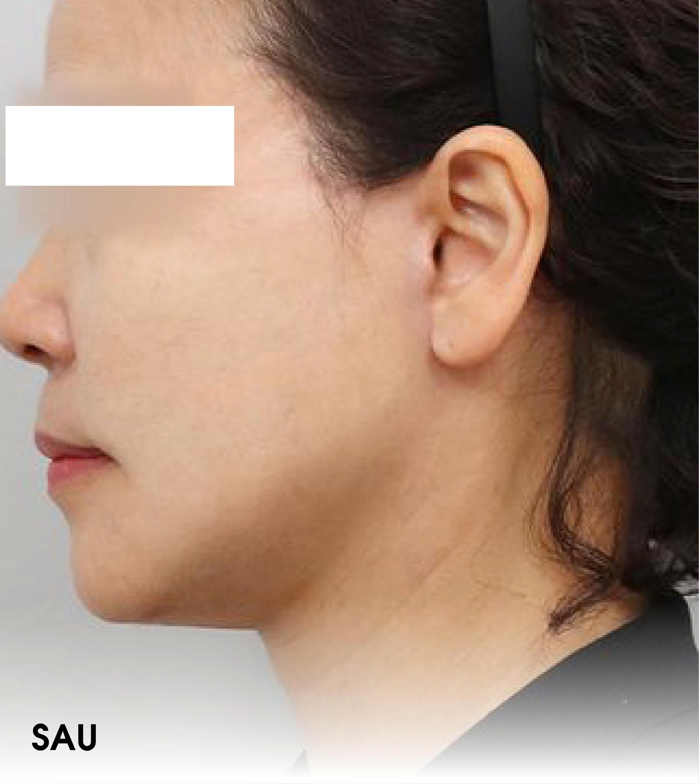 After Ultherapy