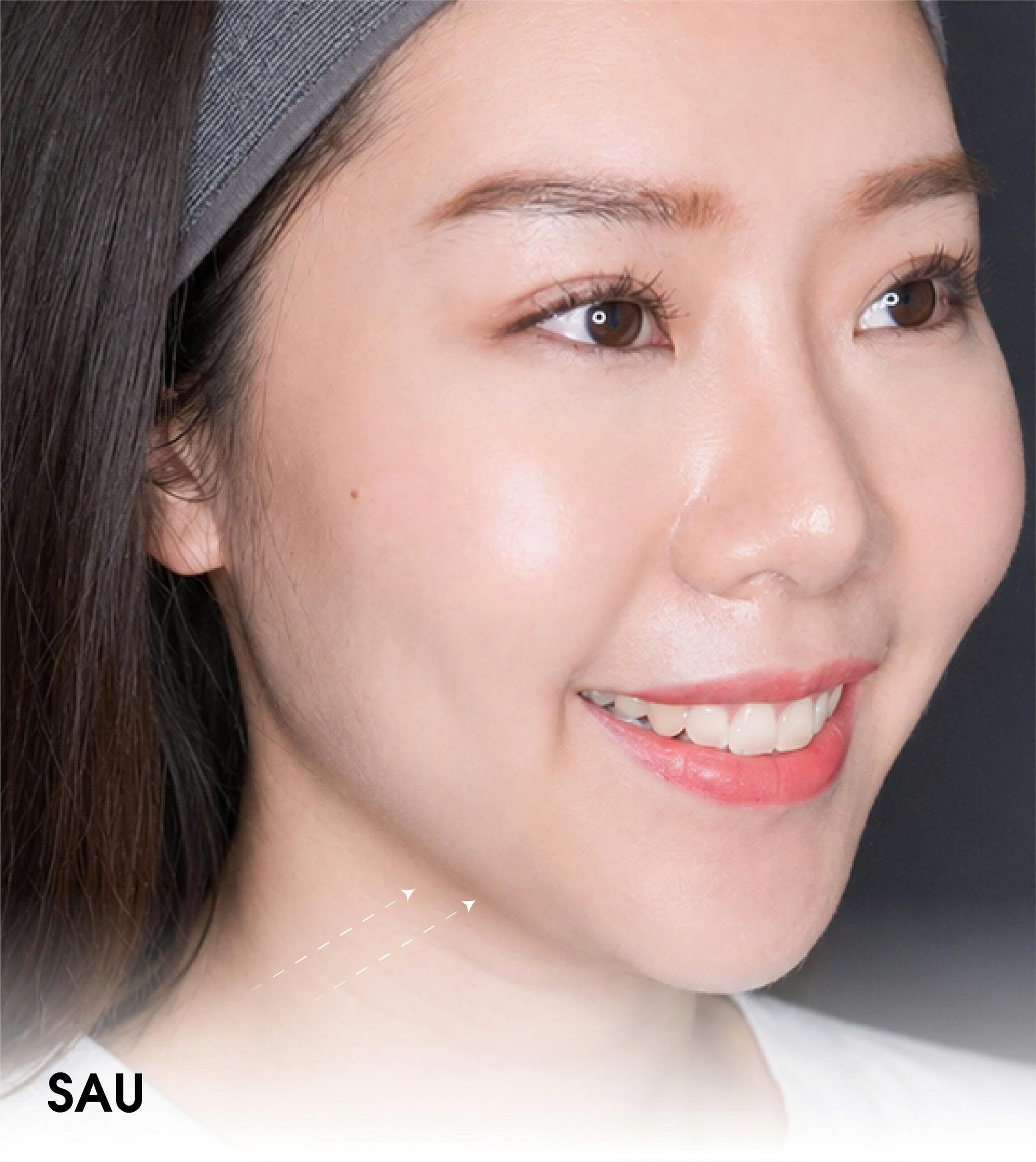 after ultherapy