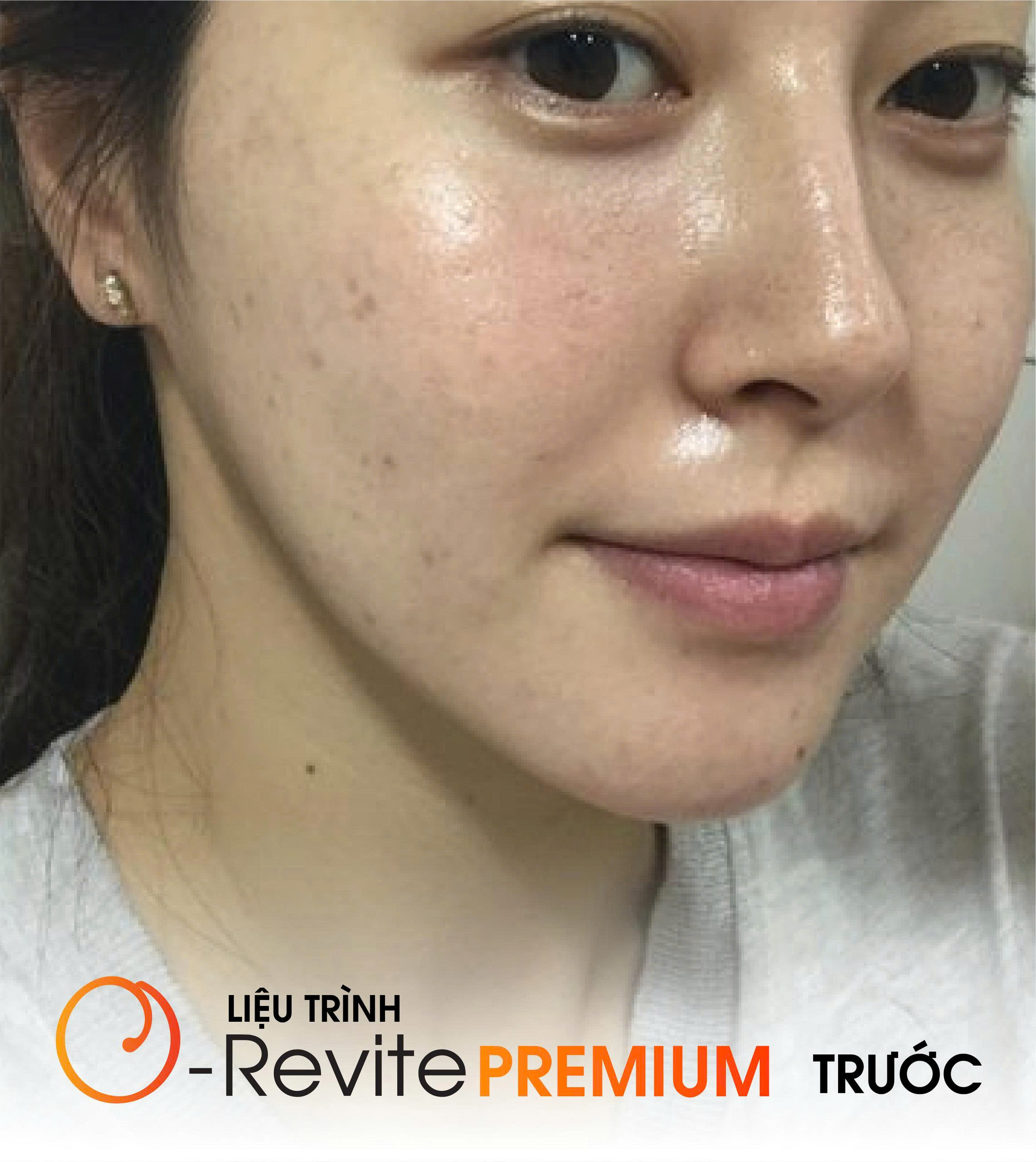Before O-revite