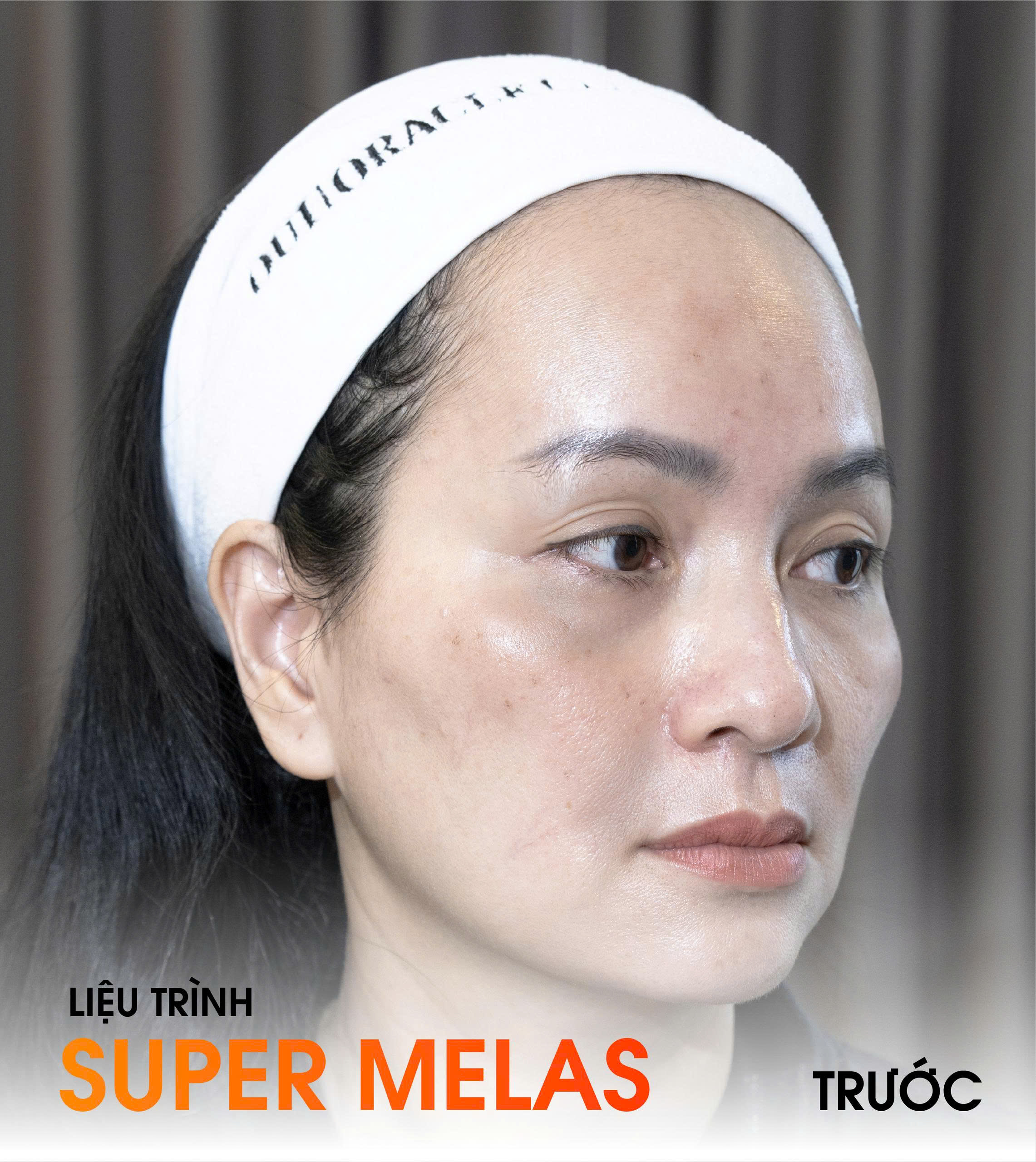 Before Super Melas