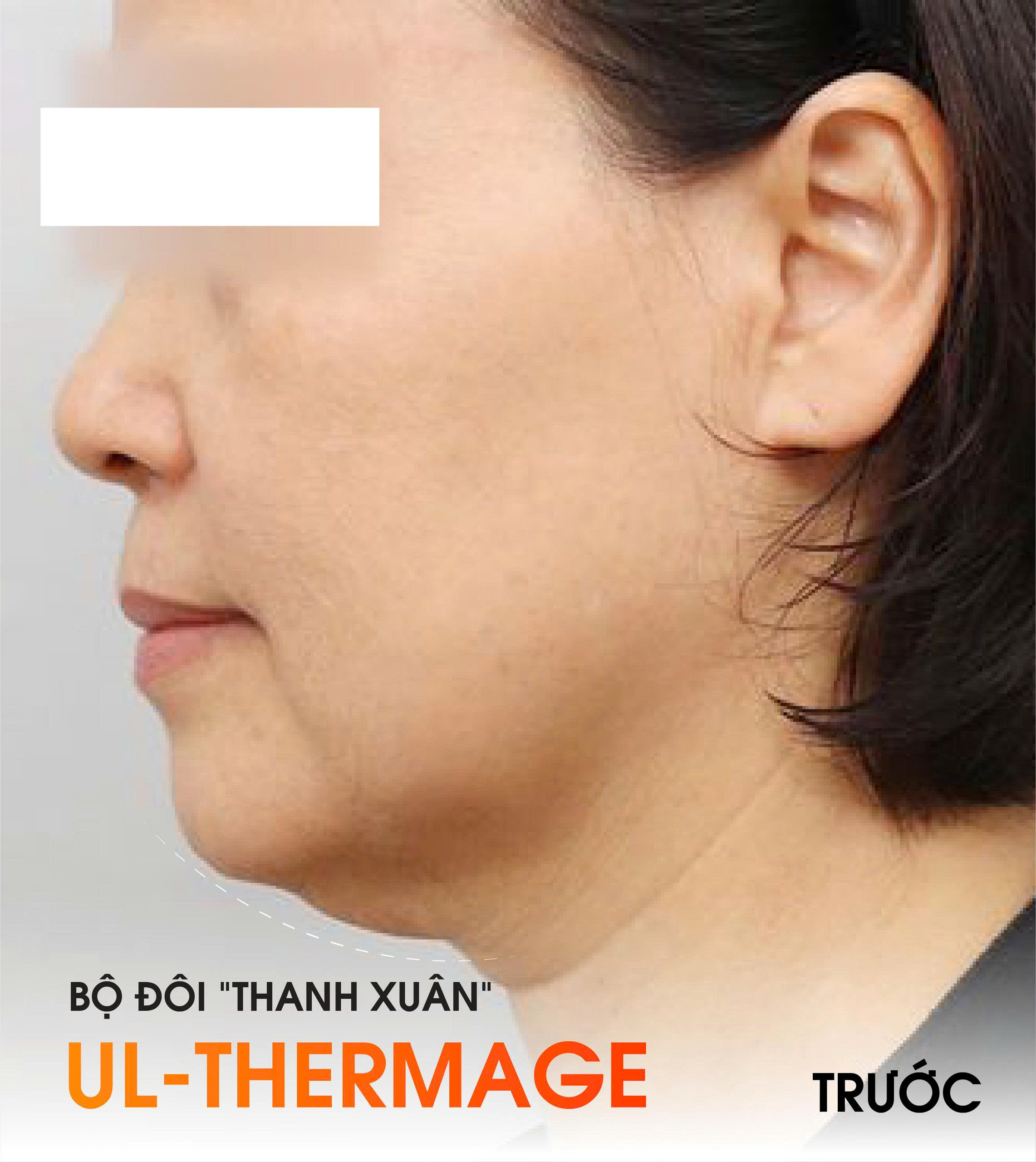 before Ultherapy