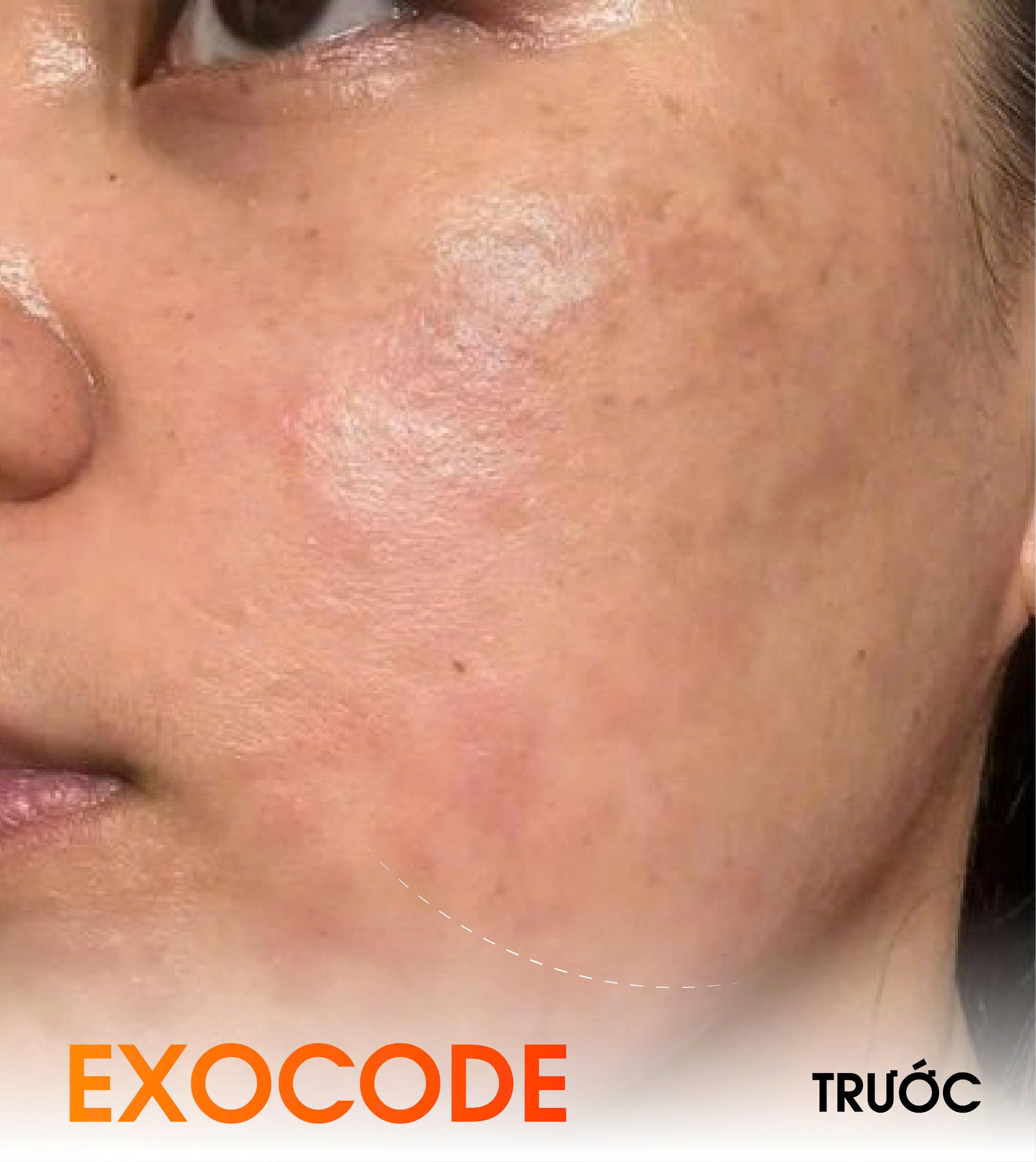 before exocode
