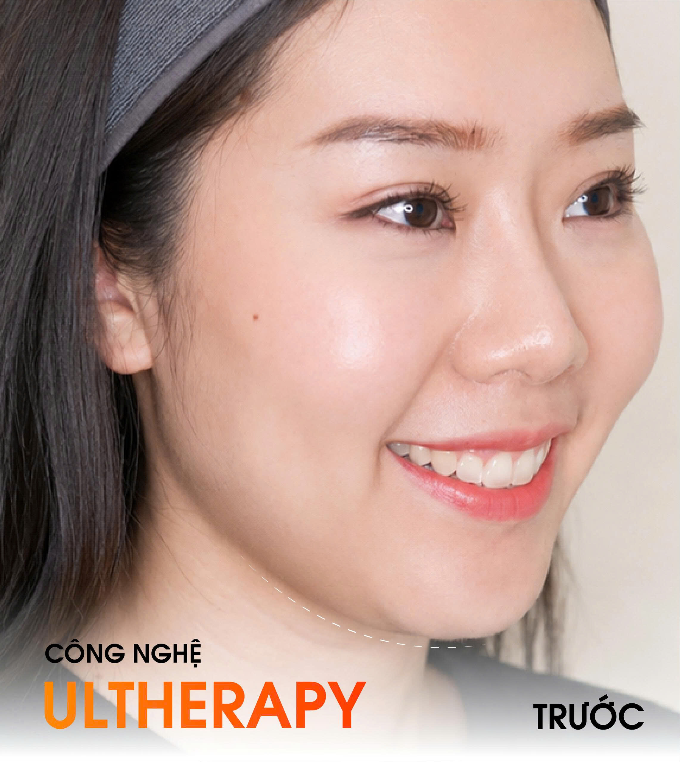 before ultherapy