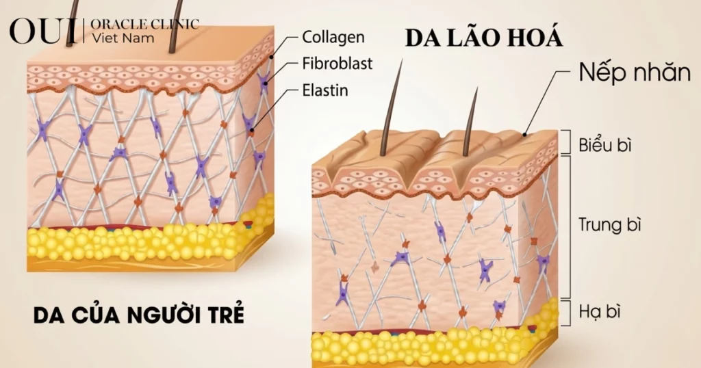 cách hết rãnh cười sâu