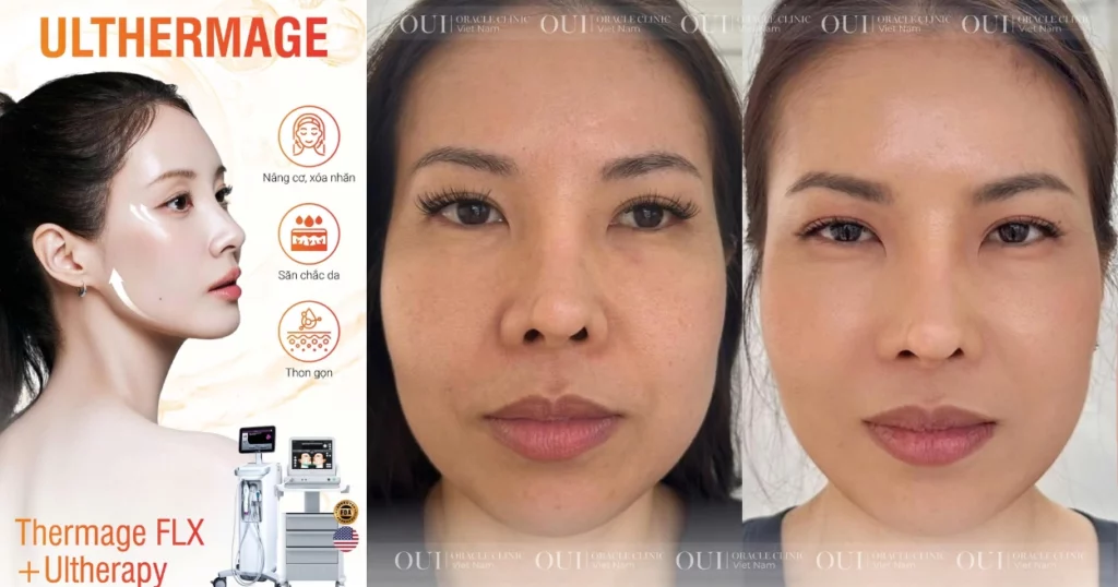 cách hết rãnh cười sâu
