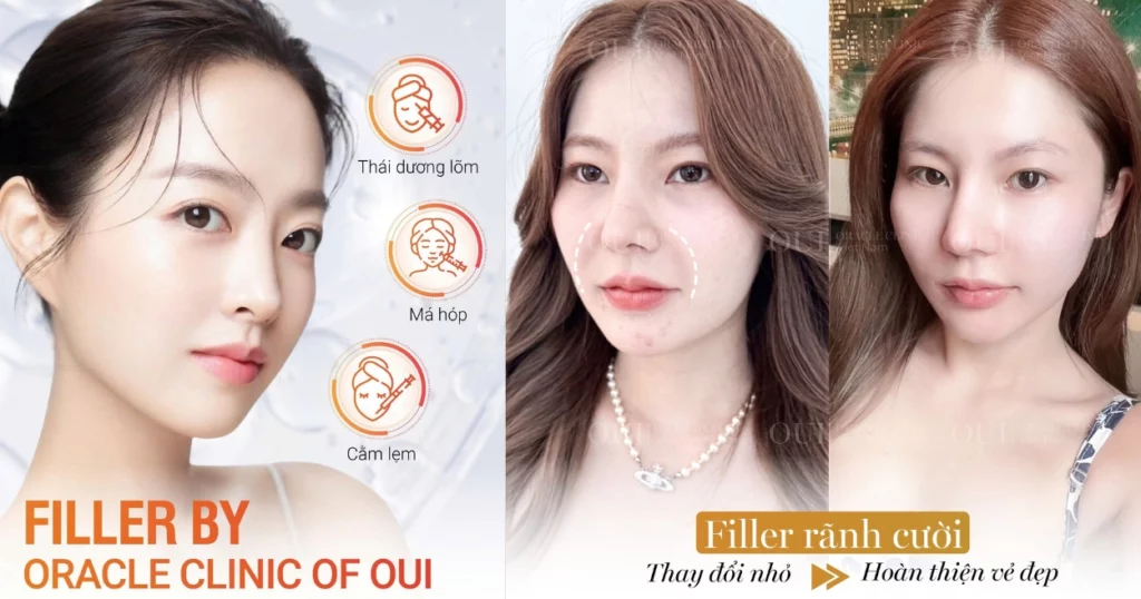 cách hết rãnh cười sâu