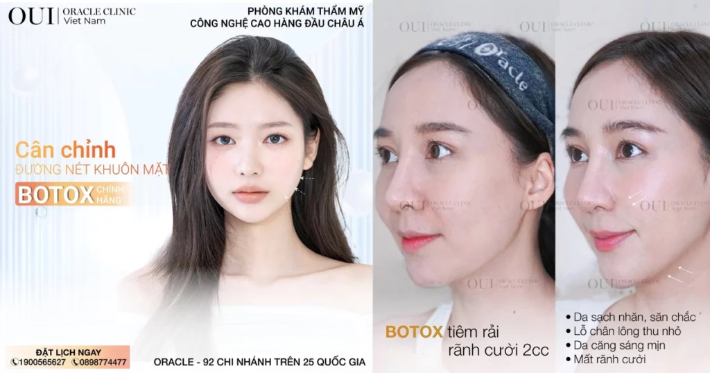 cách hết rãnh cười sâu