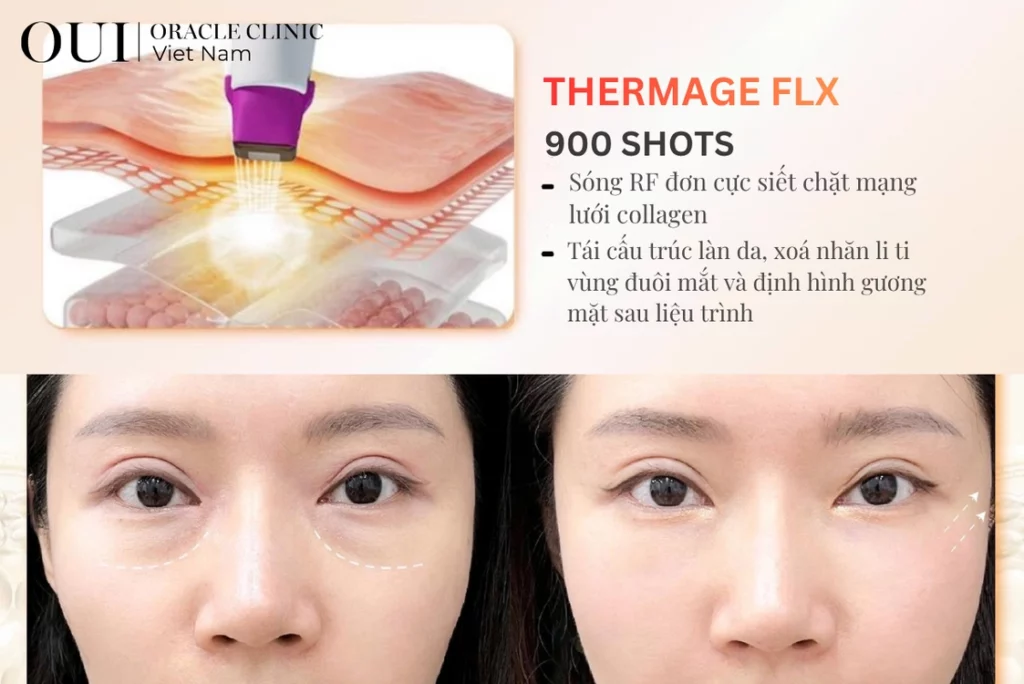 cách xóa nhanh nếp nhăn đuôi mắt 