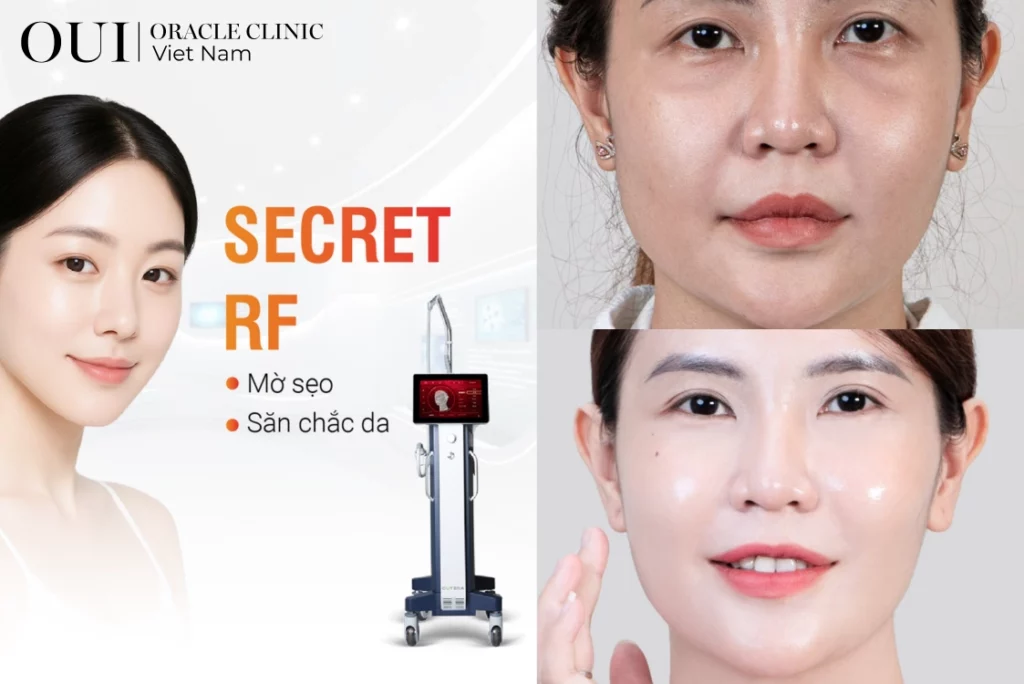 cách xóa nhanh nếp nhăn đuôi mắt 