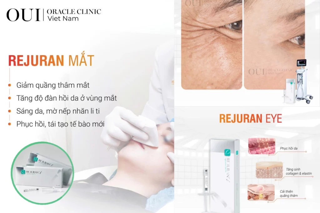 cách xóa nhanh nếp nhăn đuôi mắt 