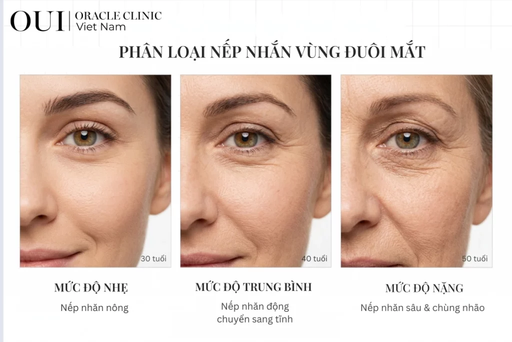 cách xóa nhanh nếp nhăn đuôi mắt 