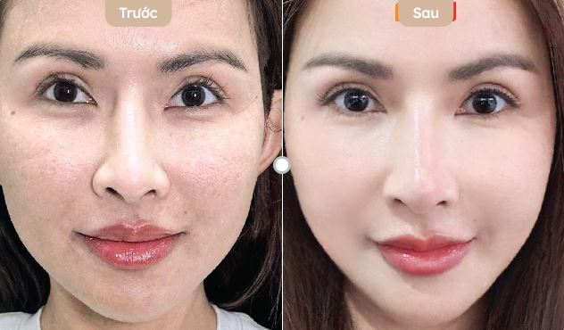 da căng bóng ngậm nước