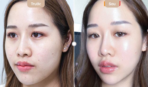 da căng bóng ngậm nước