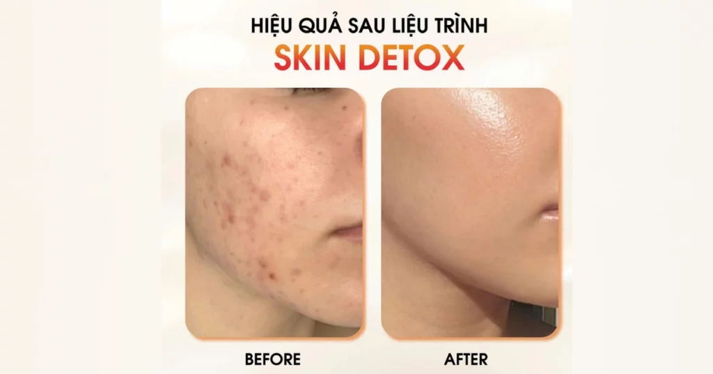 da đổ dầu nhiều nhưng vẫn khô