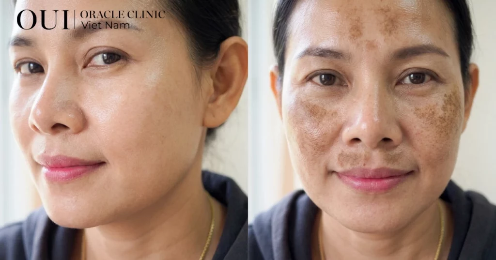da tăng sắc tố nên điều trị gì 