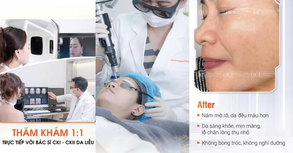 da tăng sắc tố nên điều trị gì 