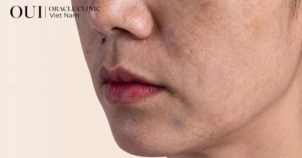 da tăng sắc tố nên điều trị gì 