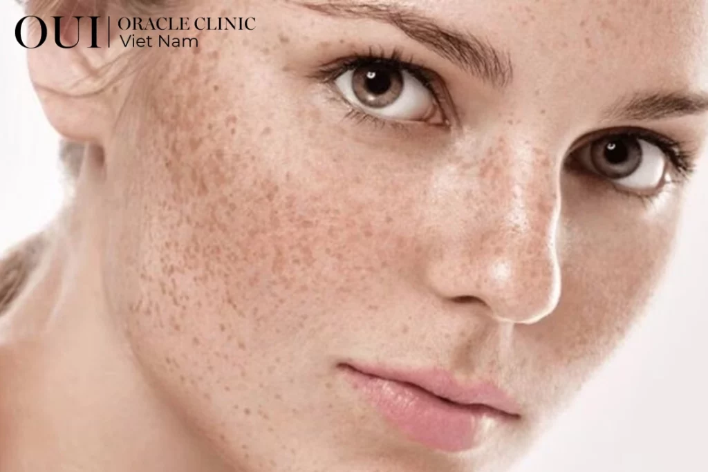laster pico trị nám vùng nào