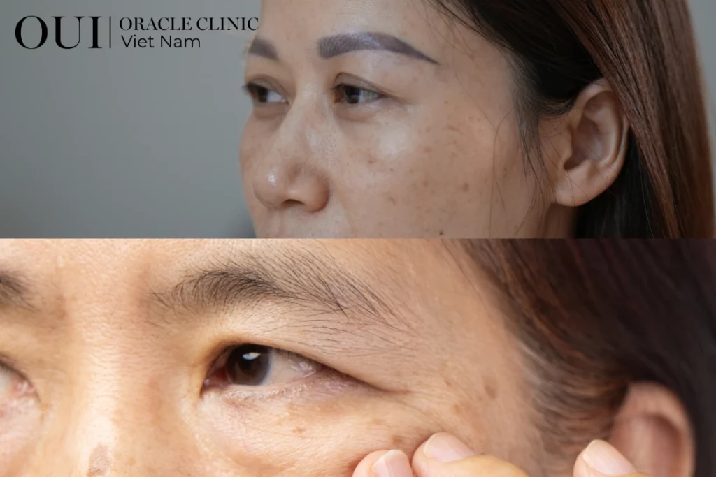 laster pico trị nám vùng nào