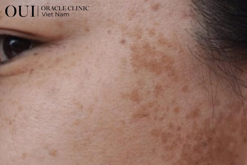 laster pico trị nám vùng nào