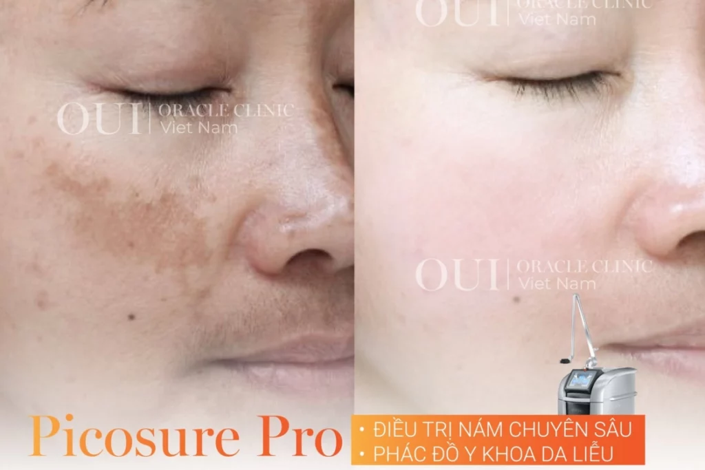 laster pico trị nám vùng nào