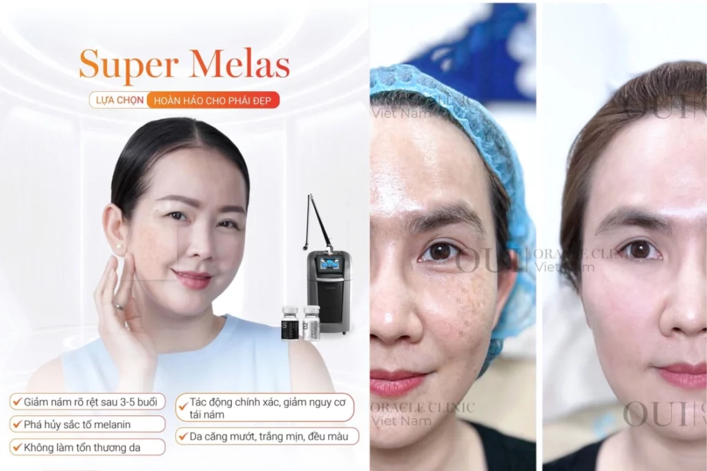 laster pico trị nám vùng nào