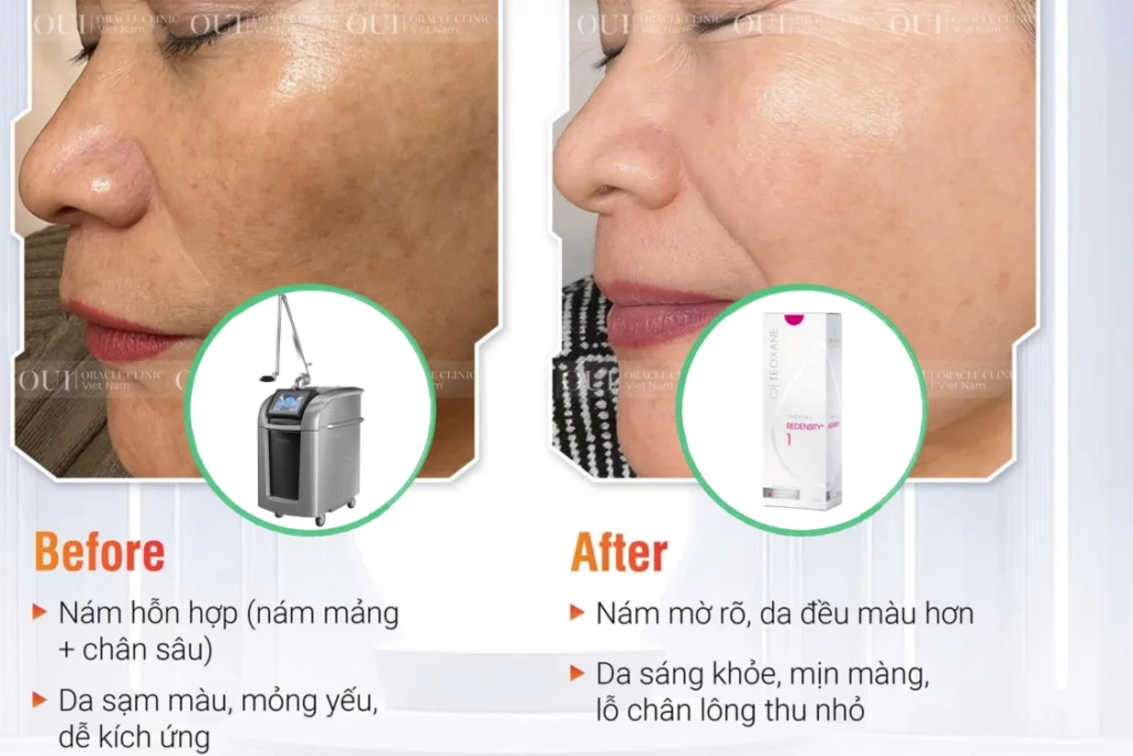 laster pico trị nám vùng nào